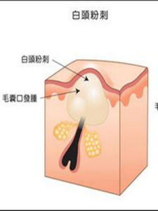 白頭粉刺