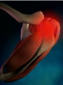 肩袖損傷 肩袖損傷