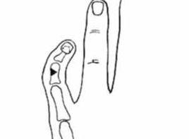 手指歪斜 手指歪斜