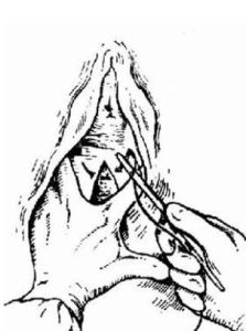 會陰側切術 會陰側切術