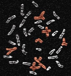 多巴反應性肌張力障礙