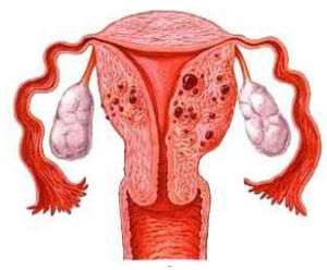 保子宮U型病灶切除術 保子宮U型病灶切除術