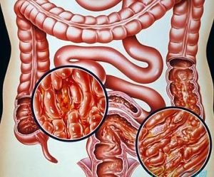 潰瘍性結腸炎 潰瘍性結腸炎