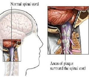 多發性硬化 多發性硬化