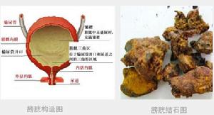 膀胱與尿道結石