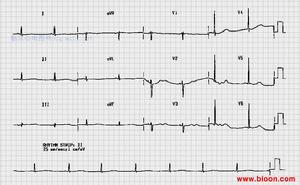 慢性特發性低鉀血症