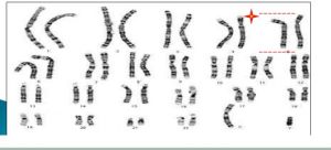 染色體短臂缺失片段