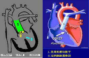 先天性主動脈弓畸形
