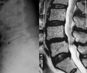 退行性脊椎滑脫 退行性脊椎滑脫