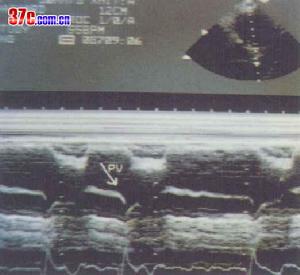 慢性肺原性心臟病