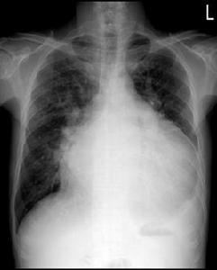 橫膈抬高 橫膈抬高