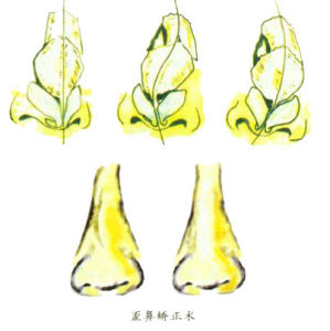 歪鼻矯正術 歪鼻矯正術