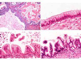 交界性腫瘤 交界性腫瘤