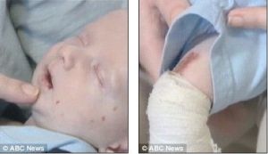 胎兒水腫綜合徵 胎兒水腫綜合徵