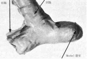 Meckel憩室 Meckel憩室