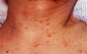 水痘和帶狀皰疹