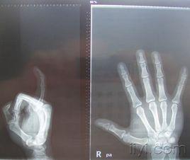 指間關節 指間關節