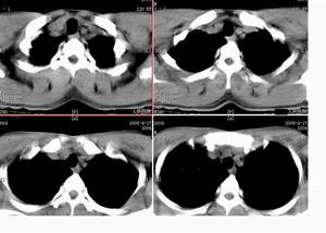 何杰金氏淋巴瘤