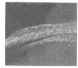 原發性急性閉角型青光眼