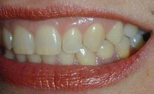 正常牙齦