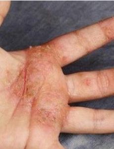 乾性濕疹 乾性濕疹