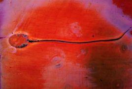 人類精液過敏症