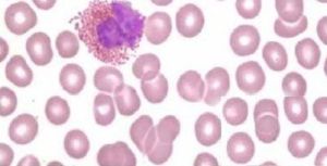 播散性嗜酸粒細胞增多性膠原病