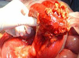 腸囊性積氣 腸囊性積氣