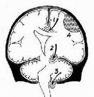 顱內低壓綜合徵