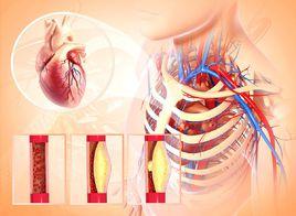 頸動脈粥樣硬化 頸動脈粥樣硬化