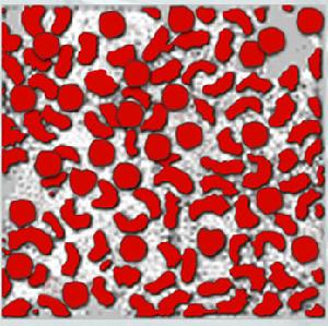 遺傳性橢圓形紅細胞增多症