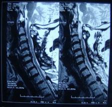 頸椎小關節紊亂綜合症 頸椎小關節紊亂綜合症