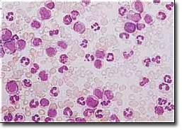 嗜鹼性粒細胞白血病