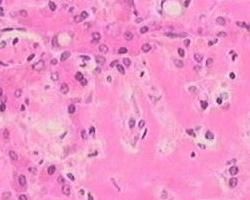 肝澱粉樣變性 肝澱粉樣變性