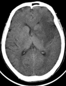 硬膜外血腫 硬膜外血腫
