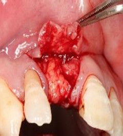 牙齦切除術 牙齦切除術