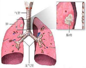 肺炎衣原體肺炎