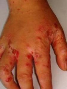 疥瘡結節 疥瘡結節