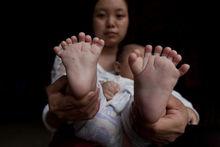 3個月大男嬰患“多指症” 手指腳趾總共31根