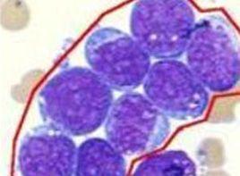 正常免疫球蛋白減少 正常免疫球蛋白減少