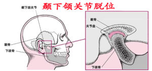顳下頜關節脫位