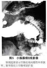 小腸腺癌 小腸腺癌