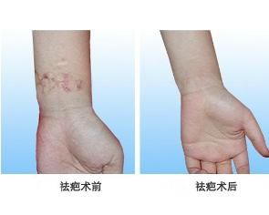 祛疤 祛疤