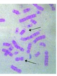 染色體異常 染色體異常