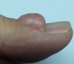 粘液樣囊腫 粘液樣囊腫