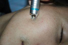 雷射祛紅血絲 雷射祛紅血絲