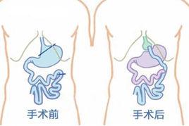 糖尿病胃轉流手術 糖尿病胃轉流手術