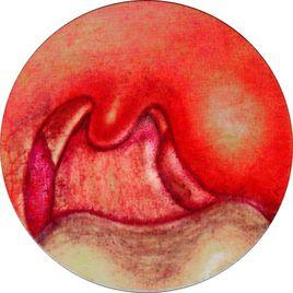 病毒性扁桃體炎 病毒性扁桃體炎