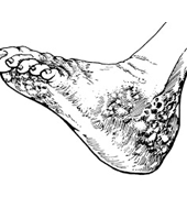 足分支菌病 足分支菌病