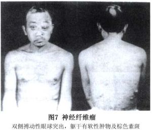 （圖）神經纖維瘤病